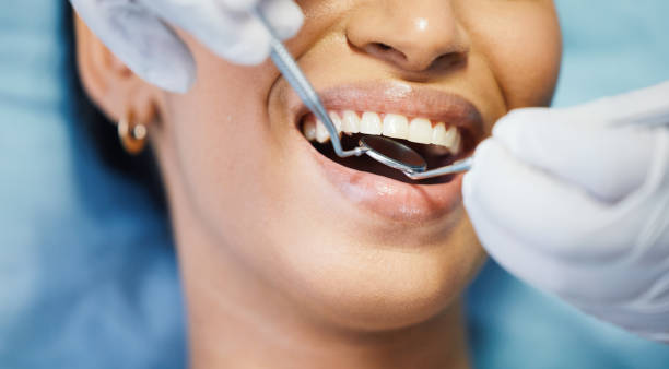 Best Knocked-Out Tooth (Avulsed Tooth) Treatment in Deer Park, OH